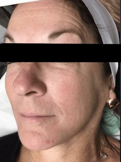Face Before & After Gallery - Patient 295316 - Image 1