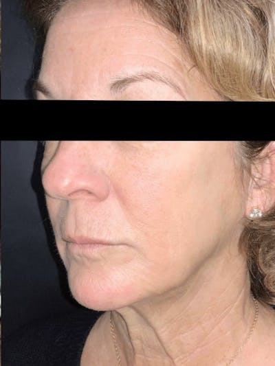 Face Before & After Gallery - Patient 295316 - Image 2