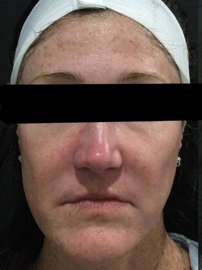 Face Before & After Gallery - Patient 196967 - Image 1