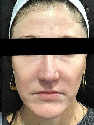 Face Before & After Gallery - Patient 196967 - Image 2