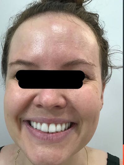 Face Before & After Gallery - Patient 249730 - Image 1