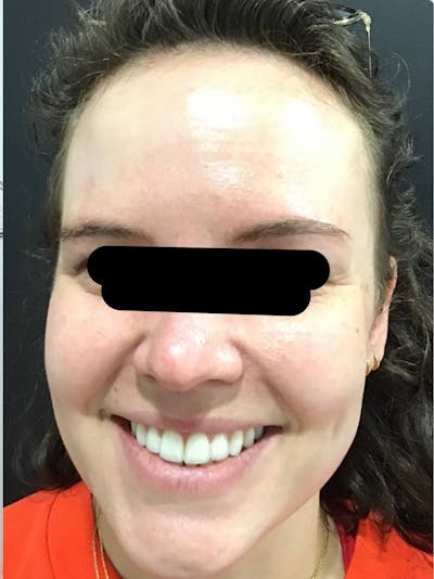 Face Before & After Gallery - Patient 249730 - Image 2
