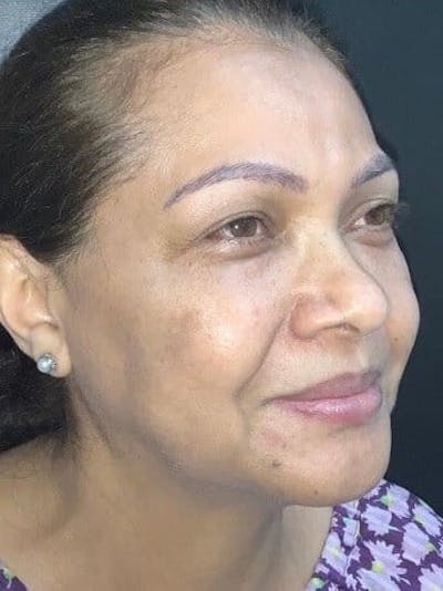 Face Before & After Gallery - Patient 107011 - Image 1