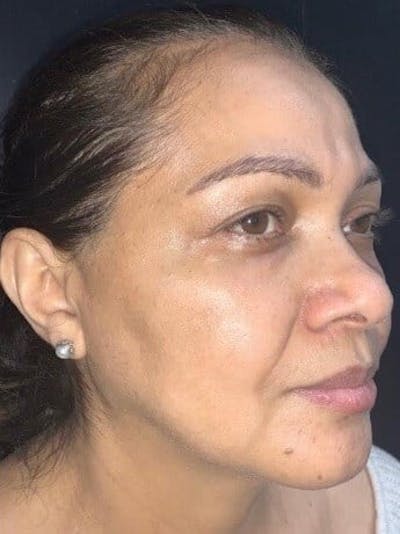 Face Before & After Gallery - Patient 107011 - Image 2