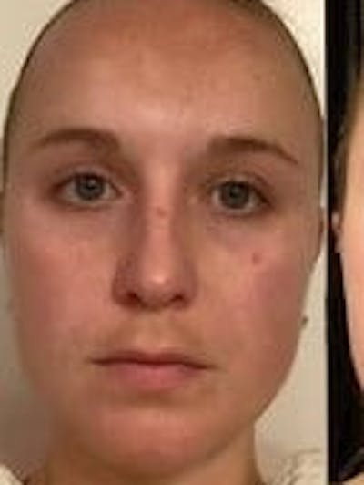 Face Before & After Gallery - Patient 908188 - Image 1