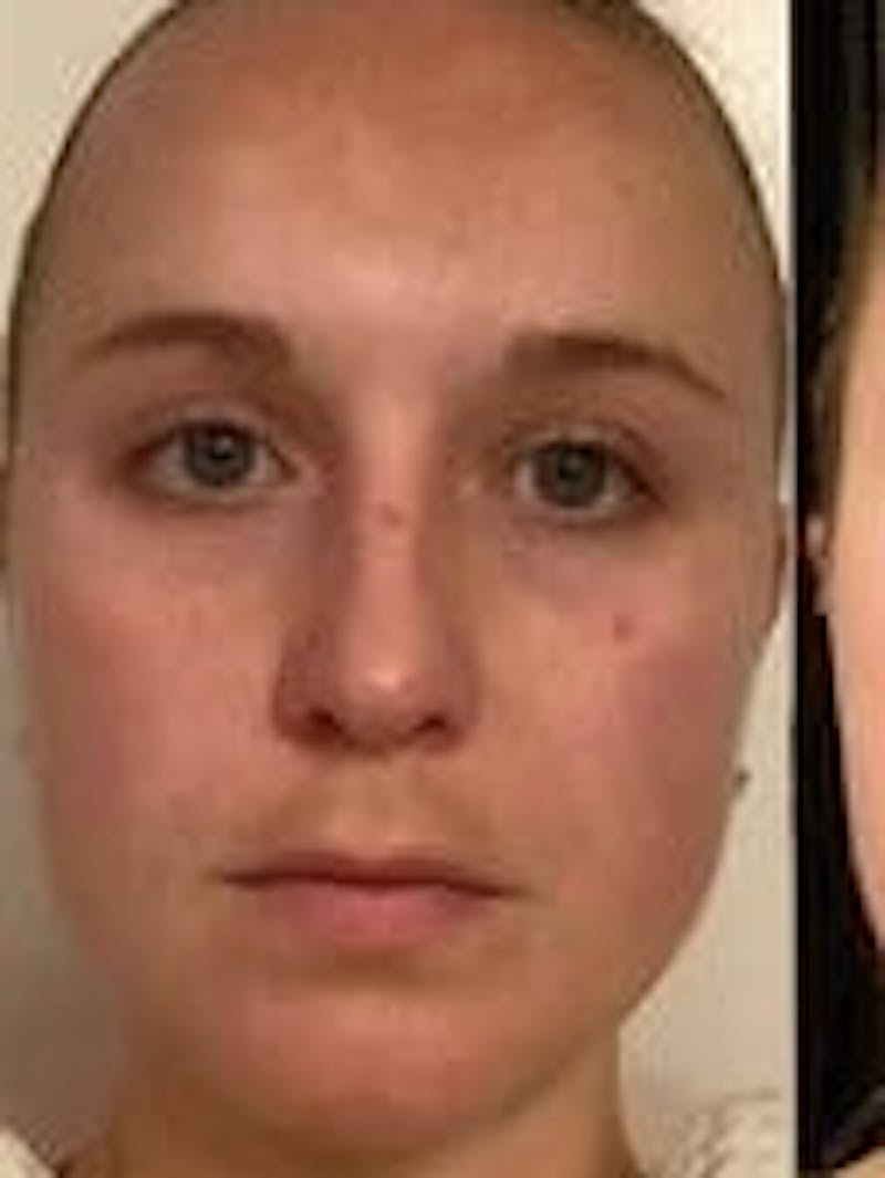 Face Before & After Gallery - Patient 908188 - Image 1