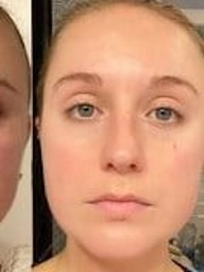 Face Before & After Gallery - Patient 908188 - Image 2