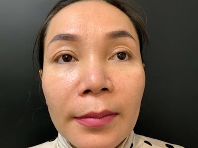 Face Before & After Gallery - Patient 219491 - Image 1