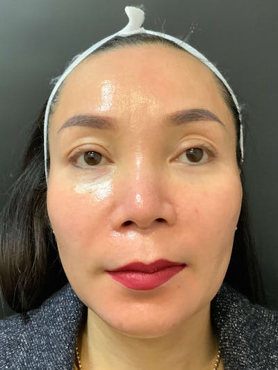 Face Before & After Gallery - Patient 219491 - Image 2