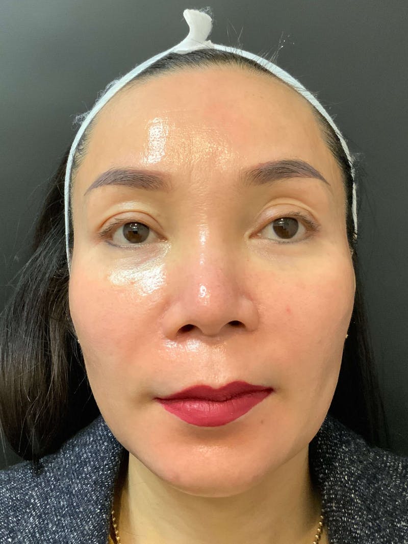 Face Before & After Gallery - Patient 219491 - Image 2