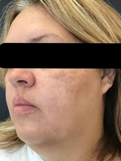 Face Before & After Gallery - Patient 219374 - Image 1
