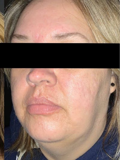 Face Before & After Gallery - Patient 219374 - Image 2
