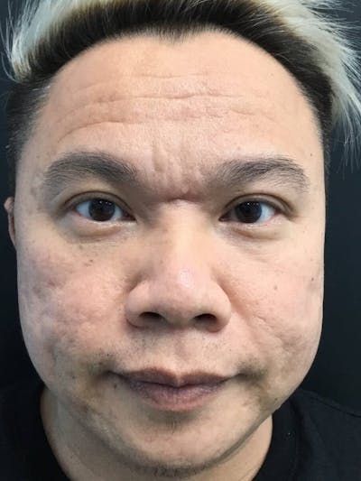 Face Before & After Gallery - Patient 198509 - Image 1