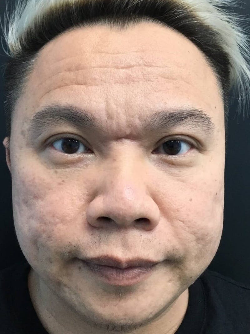 Face Before & After Gallery - Patient 198509 - Image 1