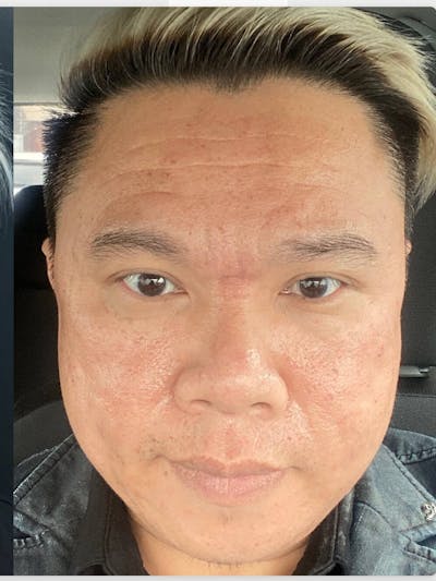 Face Before & After Gallery - Patient 198509 - Image 2