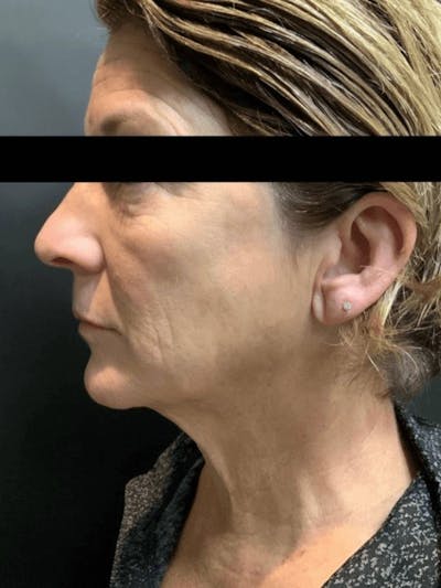 Face Before & After Gallery - Patient 179622 - Image 1