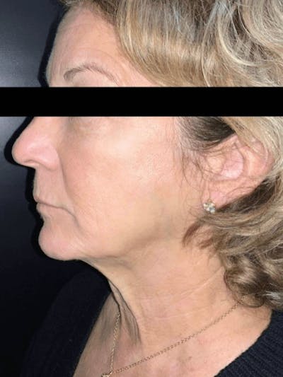 Face Before & After Gallery - Patient 179622 - Image 2