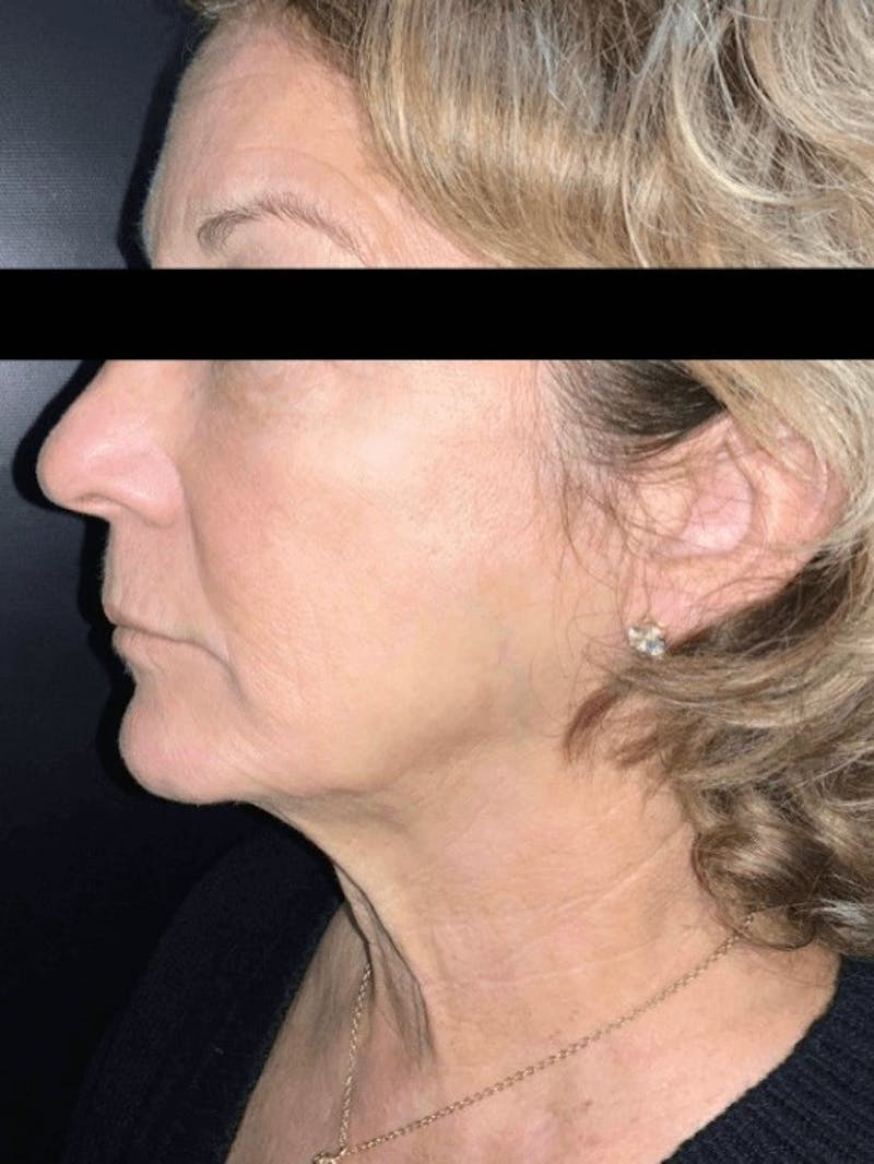 Face Before & After Gallery - Patient 179622 - Image 2