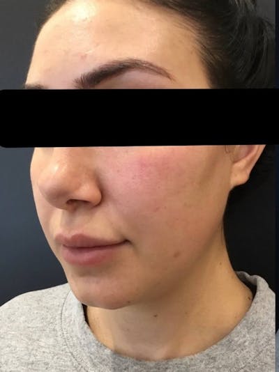 Face Before & After Gallery - Patient 418043 - Image 1
