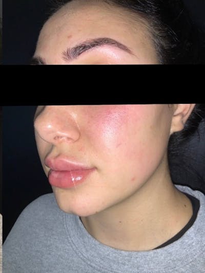 Face Before & After Gallery - Patient 418043 - Image 2