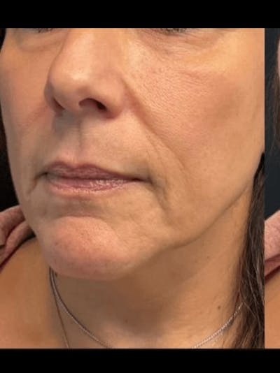Face Before & After Gallery - Patient 230862 - Image 1