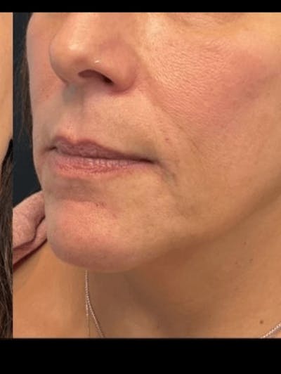 Face Before & After Gallery - Patient 230862 - Image 2