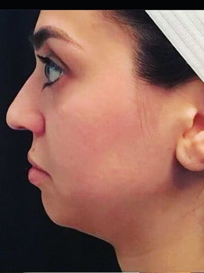 Lips Before & After Gallery - Patient 171591 - Image 1