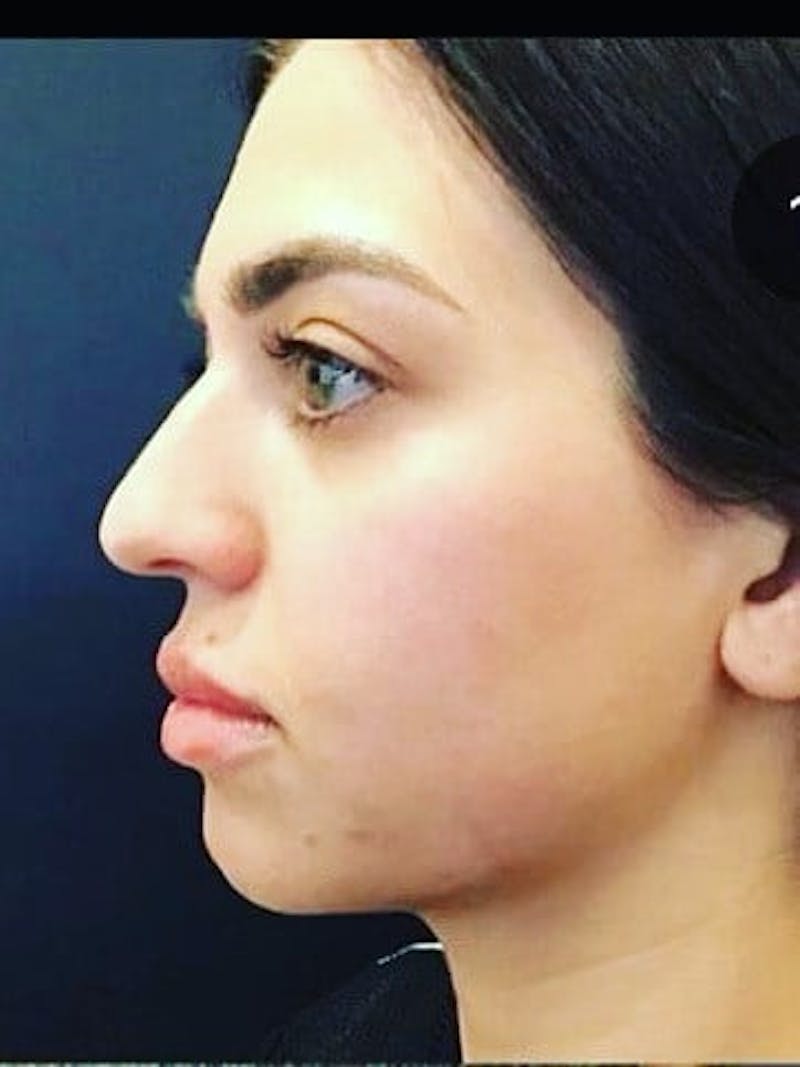 Lips Before & After Gallery - Patient 171591 - Image 2
