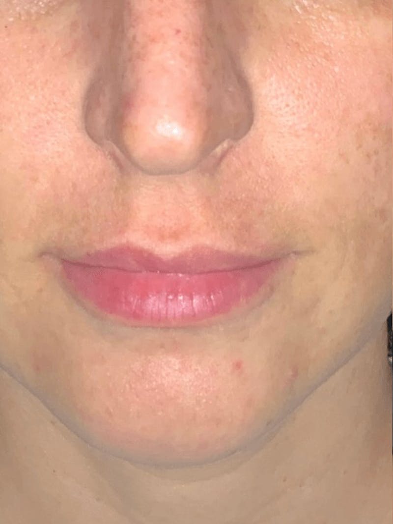 Lips Before & After Gallery - Patient 138156 - Image 1