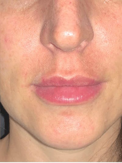 Lips Before & After Gallery - Patient 138156 - Image 2