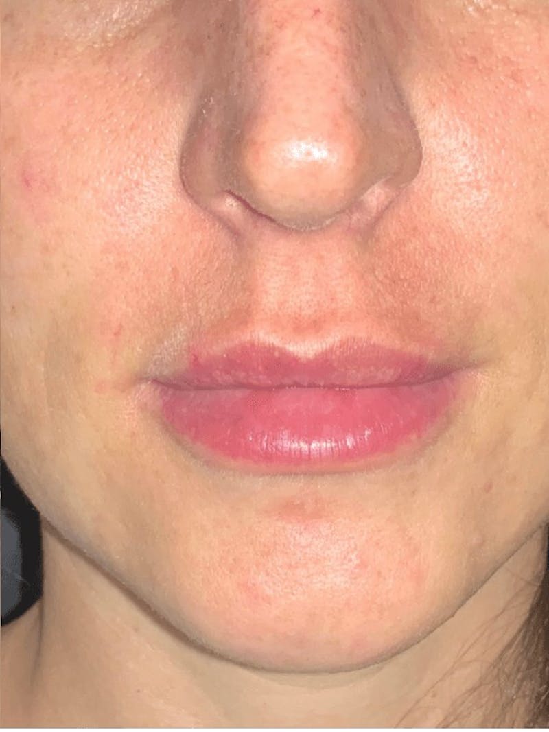 Lips Before & After Gallery - Patient 138156 - Image 2