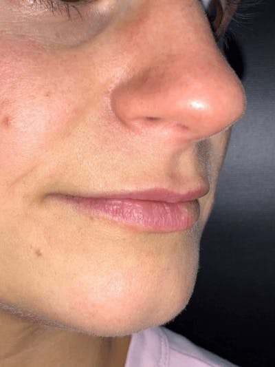 Lips Before & After Gallery - Patient 307734 - Image 1