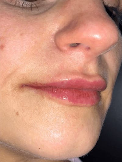 Lips Before & After Gallery - Patient 307734 - Image 2
