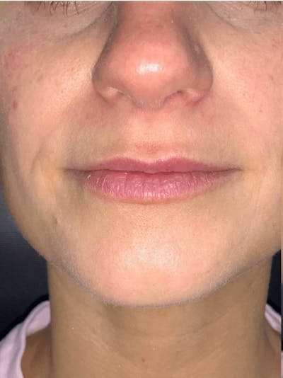 Lips Before & After Gallery - Patient 146160 - Image 1
