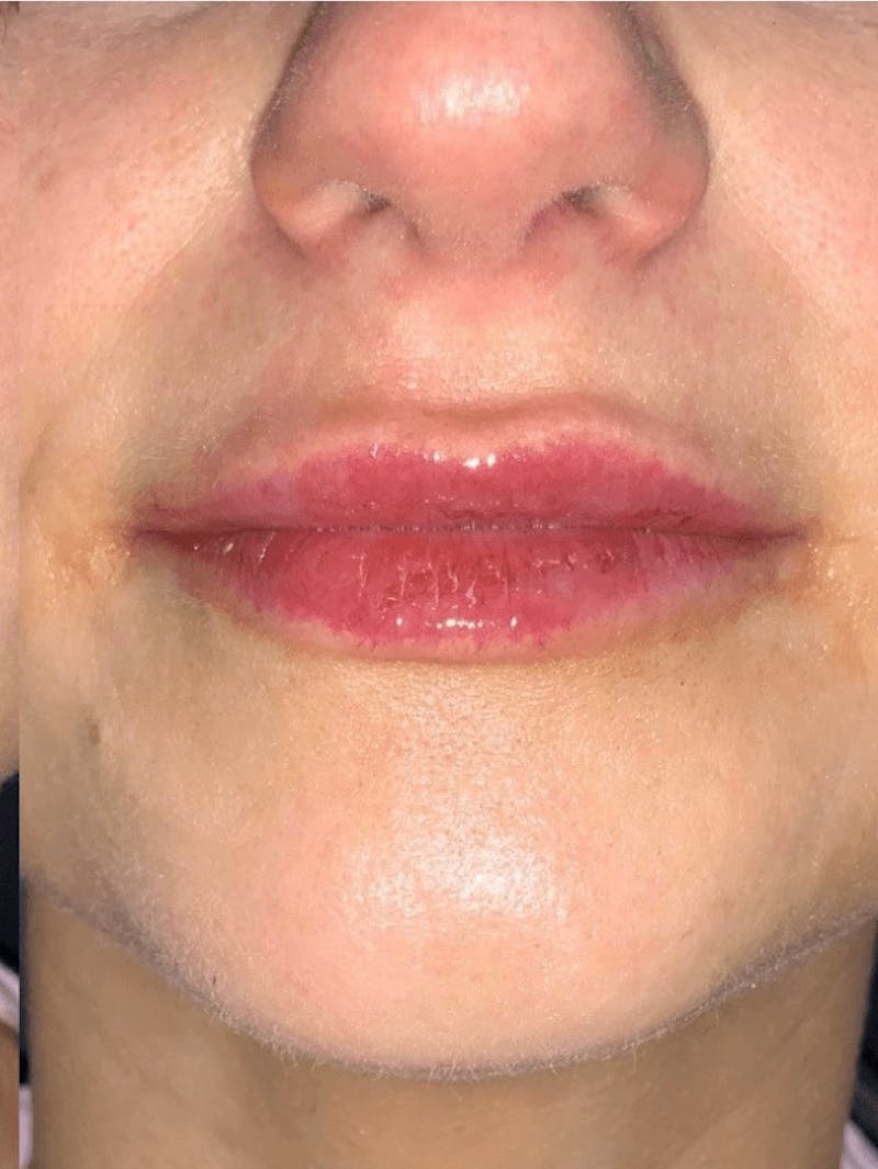 Lips Before & After Gallery - Patient 146160 - Image 2