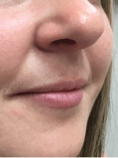 Lips Before & After Gallery - Patient 621045 - Image 1