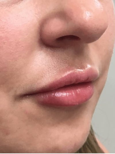 Lips Before & After Gallery - Patient 621045 - Image 2