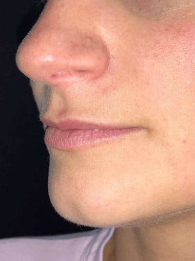 Lips Before & After Gallery - Patient 208859 - Image 1