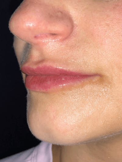 Lips Before & After Gallery - Patient 208859 - Image 2