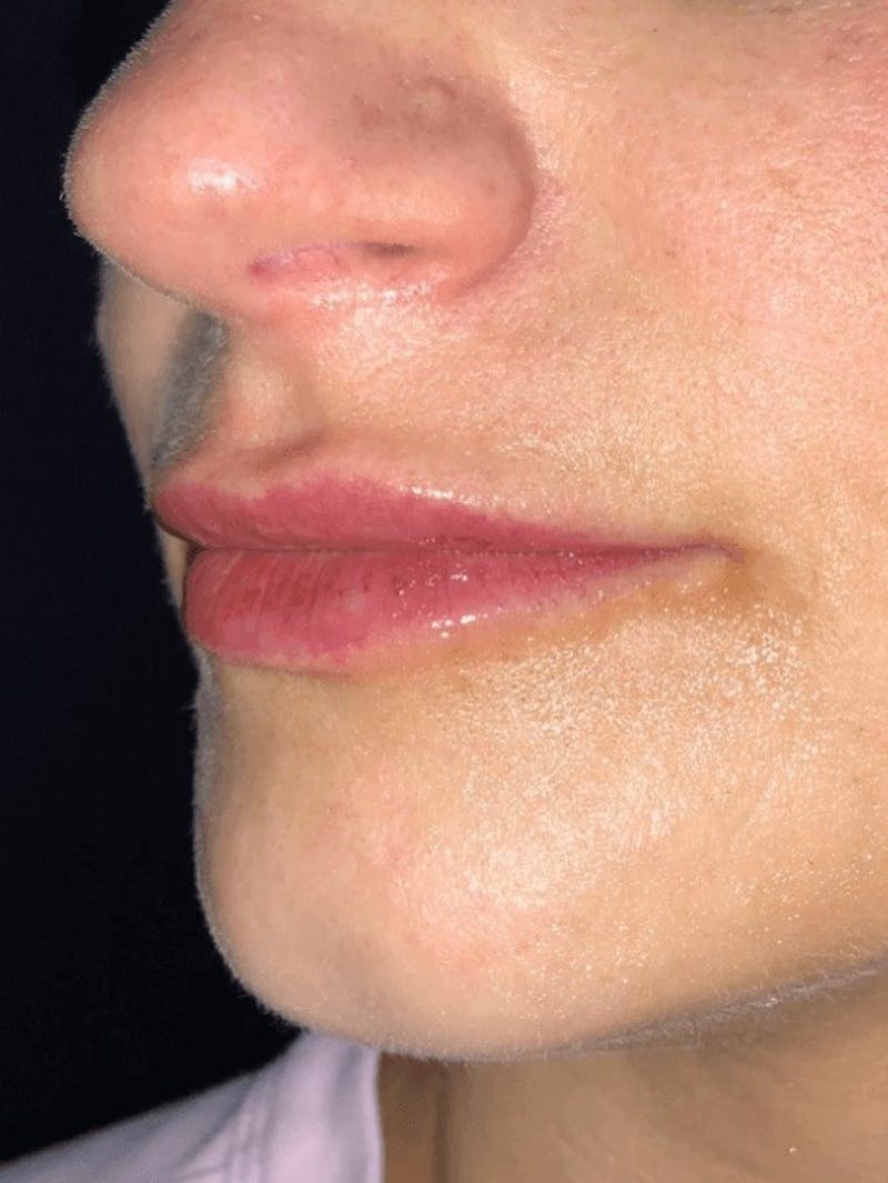 Lips Before & After Gallery - Patient 208859 - Image 2
