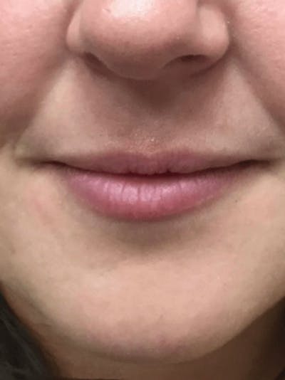 Lips Before & After Gallery - Patient 304937 - Image 1
