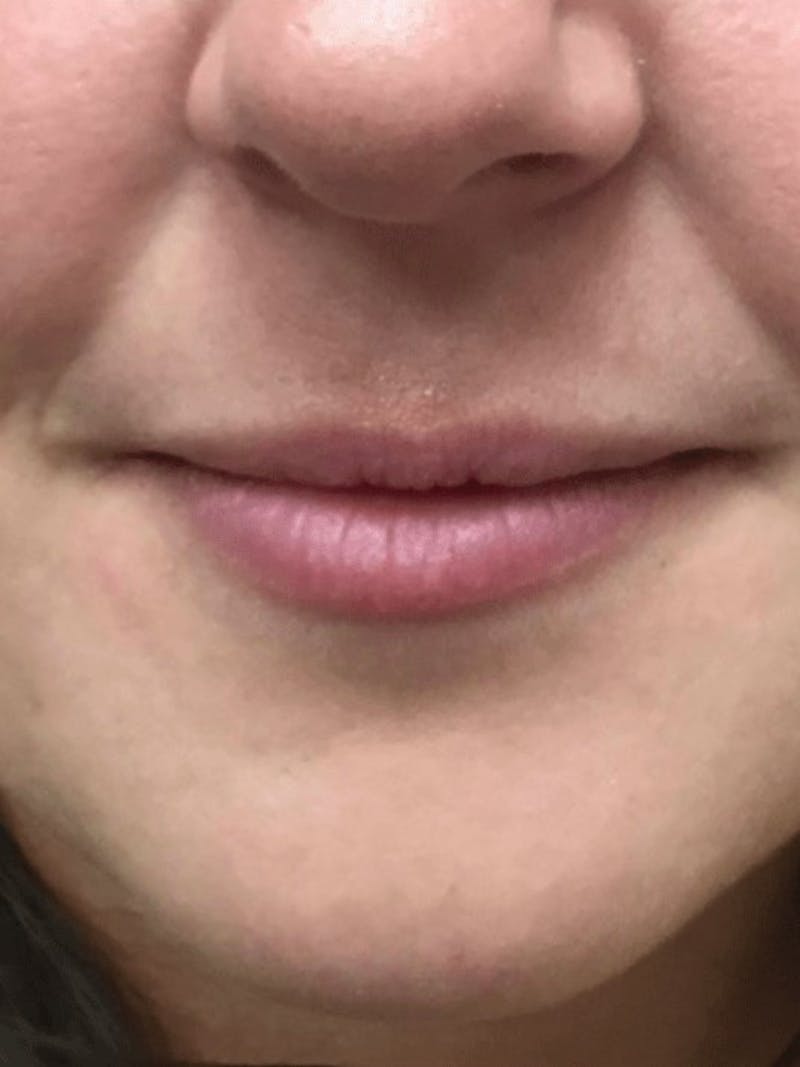 Lips Before & After Gallery - Patient 304937 - Image 1