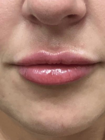 Lips Before & After Gallery - Patient 304937 - Image 2