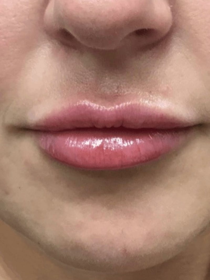 Lips Before & After Gallery - Patient 304937 - Image 2
