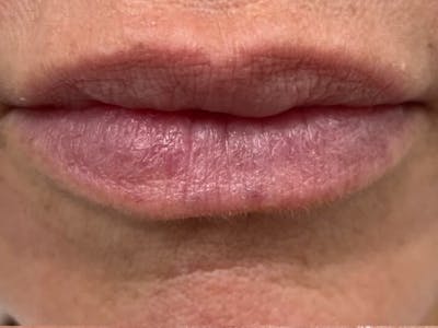 Lips Before & After Gallery - Patient 176117 - Image 1