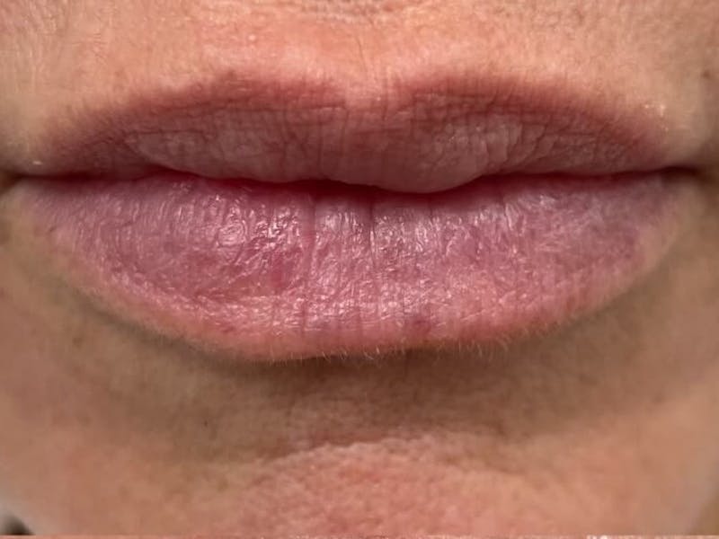 Lips Before & After Gallery - Patient 176117 - Image 1