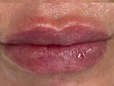 Lips Before & After Gallery - Patient 176117 - Image 2
