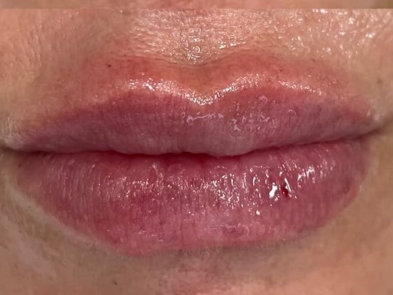Lips Before & After Gallery - Patient 176117 - Image 2