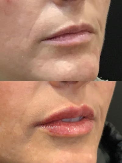 Lips Before & After Gallery - Patient 715647 - Image 1