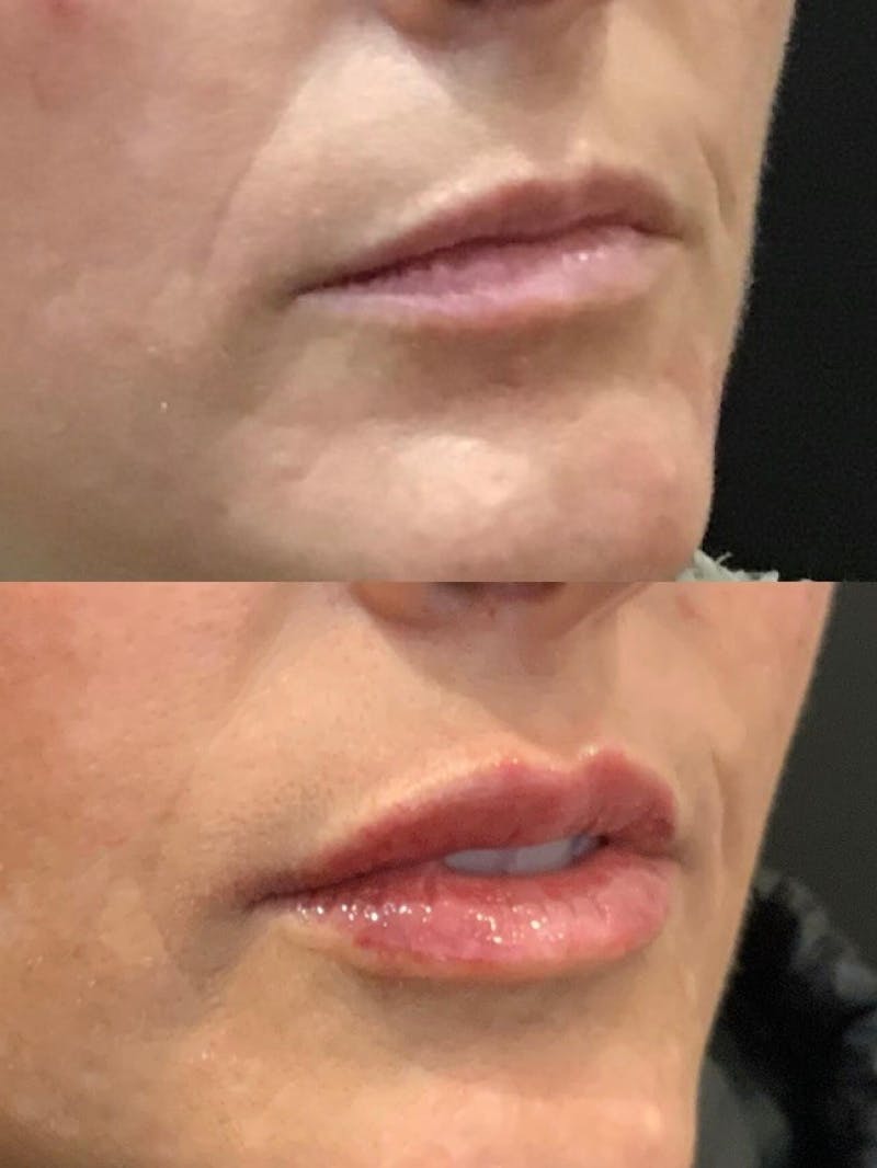 Lips Before & After Gallery - Patient 715647 - Image 1